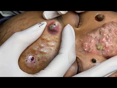 relax,Satisfying,nose blackheads,tweezers,acne treatment,鼻角栓,ピンセット,피지제거 019