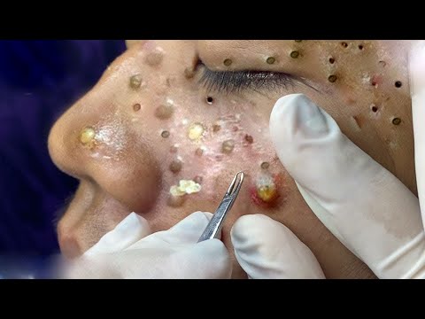 relax,Satisfying,blackheads,tweezers,acne treatment,鼻角栓,ピンセット,피지제거 003 1